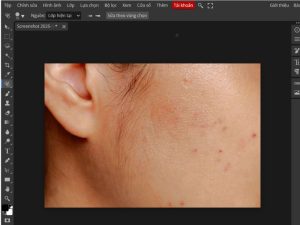 Cách xóa mụn trong Photoshop Online nhanh