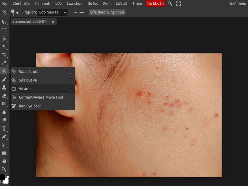 Chọn công cụ vá ảnh để xử lý mụn