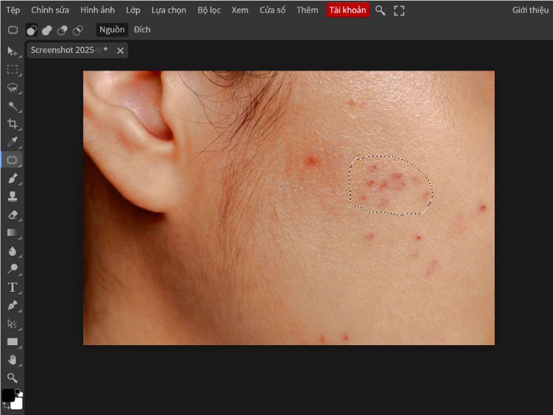 Khoanh vùng mụn cần xóa bằng chuột