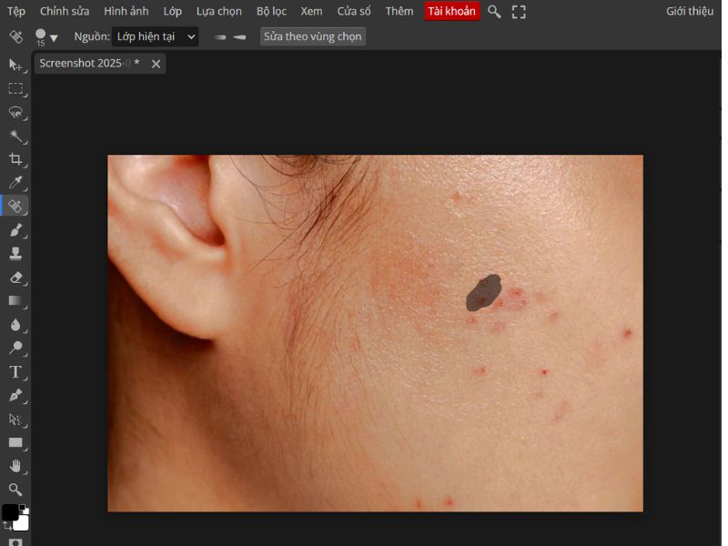 Nhấp chuột vào vùng mụn để làm sạch